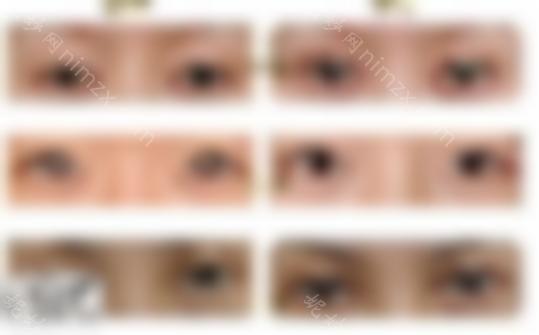 眼睛修复过宽的双眼皮修复，双眼皮宽窄怎么办？