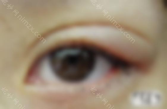 眼睛修复过宽的双眼皮修复，双眼皮宽窄怎么办？