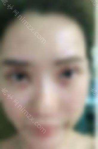 分享潘双眼皮修复案例~术后效果如何？双眼皮修复成功案例