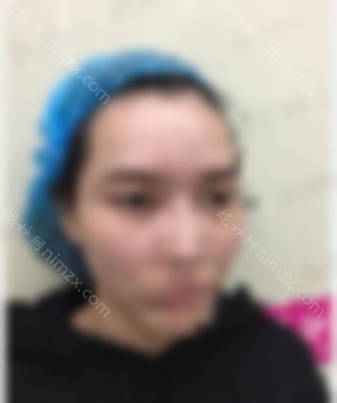分享潘双眼皮修复案例~术后效果如何？双眼皮修复成功案例