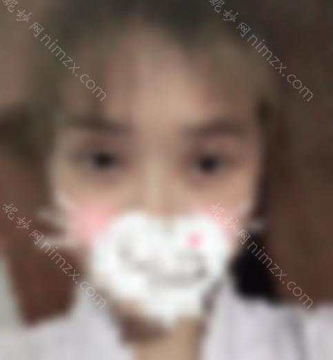 分享潘双眼皮修复案例~术后效果如何？双眼皮修复成功案例