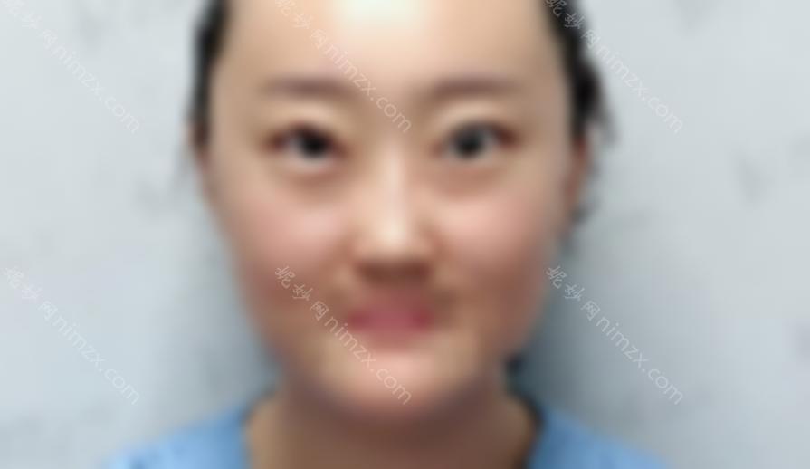 张冰洁修好贵！但是效果真的很好！来看看我的双眼皮修复经验吧！