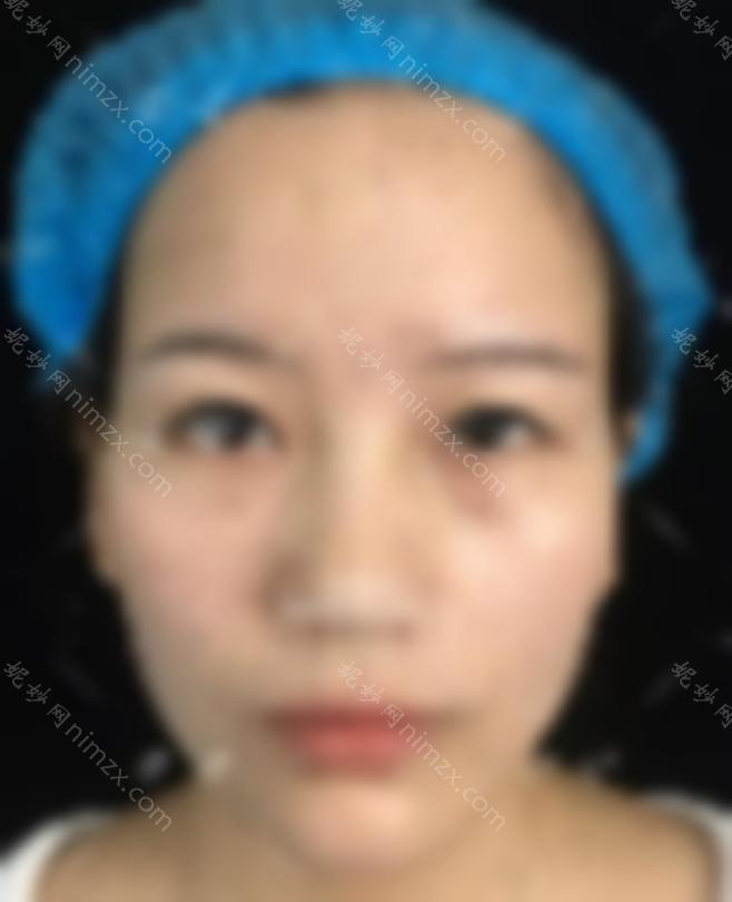上海双眼皮修复能力强的医生排名:朱海男amp;王俊芳amp;宋楠等，都是修复高手！