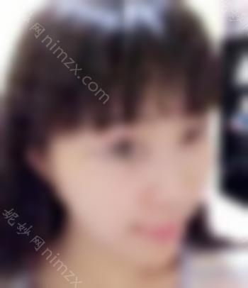 开眼角前后对比照片 向女神迈进了一步