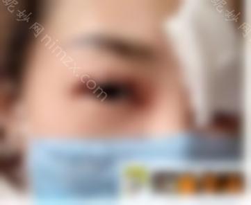 深圳周洪超开眼角塑形 双眼皮病例恢复|美丽日记