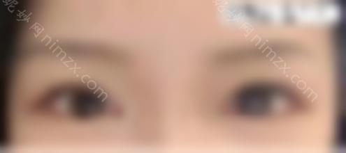 王海平的眼部修复手术怎么样？医生的技术好吗？双眼皮修复案例