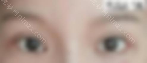 王海平的眼部修复手术怎么样？医生的技术好吗？双眼皮修复案例