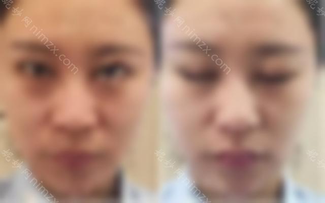 为什么双眼皮修复这么贵？