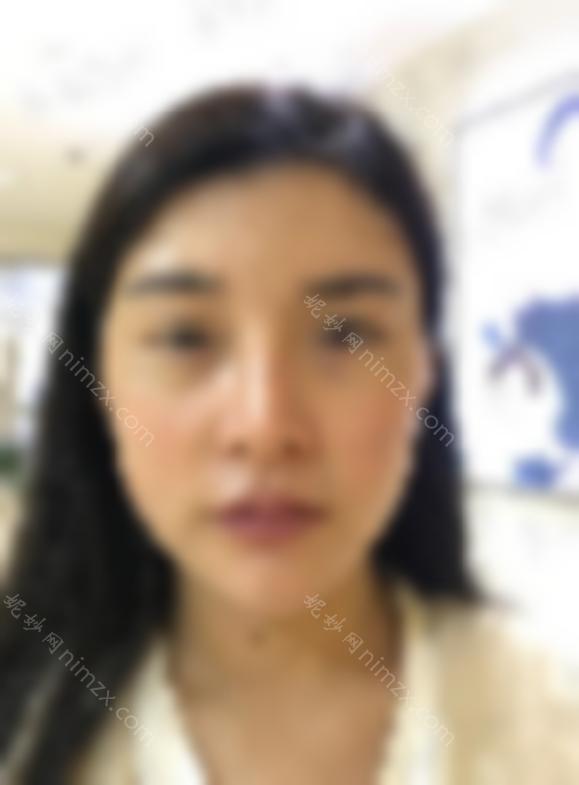 北京张冰洁技术好么？做开眼角如何？内附真实案例分享