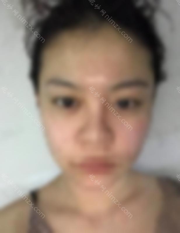 黔南州人民医院整形手术案件袭击！附双眼皮整形术后恢复图分享