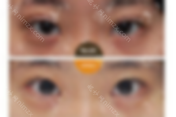 北京丰联丽格师丽丽双眼皮修复好吗？什么时候修好？