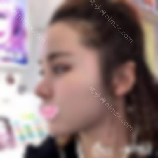 鼻小柱延长 鼻缩小 耳软骨垫鼻尖病例