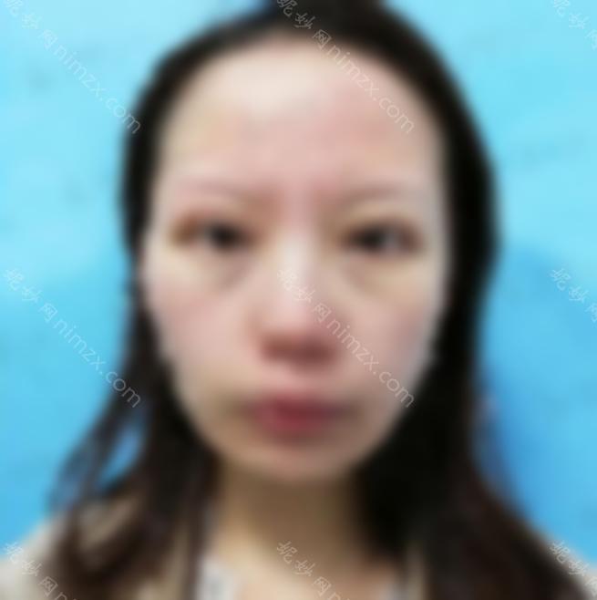 分享李光琴双眼皮修复真实案例~术后效果令人惊讶