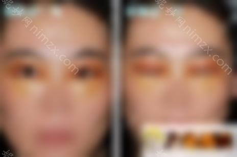 双眼皮修复 自体脂肪填充眼窝效果图，拯救无神眼！