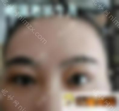 双眼皮修复 自体脂肪填充眼窝效果图，拯救无神眼！