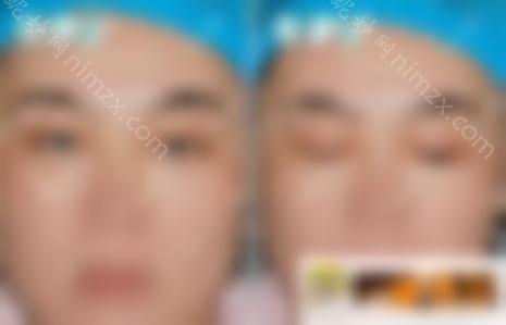 双眼皮修复 自体脂肪填充眼窝效果图，拯救无神眼！
