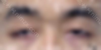 北京眼科综合医生名单曝光，排名单上双眼皮修复牛人