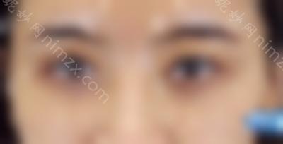 北京眼科综合医生名单曝光，排名单上双眼皮修复牛人