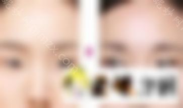 睁开眼角有风险吗？术后护理是关键，告诉你术后应该这样做...
