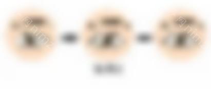 开眼角未能修复成功案例~修复后有漂亮的电眼，如何避免开眼角失败？