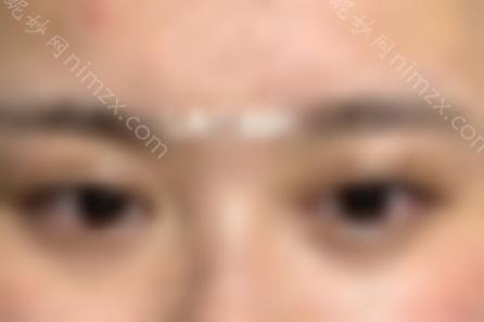 朴相根院长的双眼皮修复怎么样？让我们来看看真实的案例分享，重生~