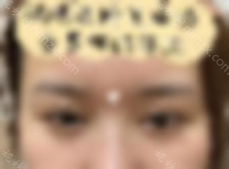 朴相根院长的双眼皮修复怎么样？让我们来看看真实的案例分享，重生~