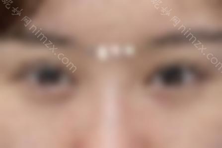 朴相根院长的双眼皮修复怎么样？让我们来看看真实的案例分享，重生~