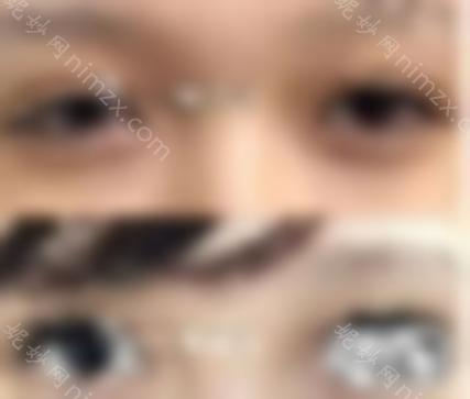 专业眼部修复医生带来双眼皮修复十大核心知识点