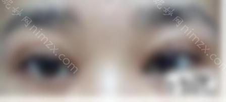 专业眼部修复医生带来双眼皮修复十大核心知识点