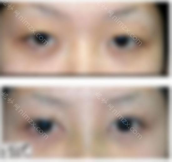 专业眼部修复医生带来双眼皮修复十大核心知识点