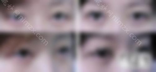 专业眼部修复医生带来双眼皮修复十大核心知识点