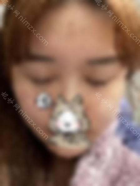 朴相根院长的双眼皮修复怎么样？让我们来看看真实的案例分享，重生~