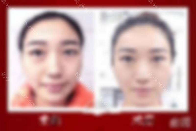 还有人不知道无痕祛眼袋？