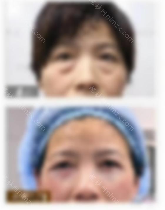 还有人不知道无痕祛眼袋？