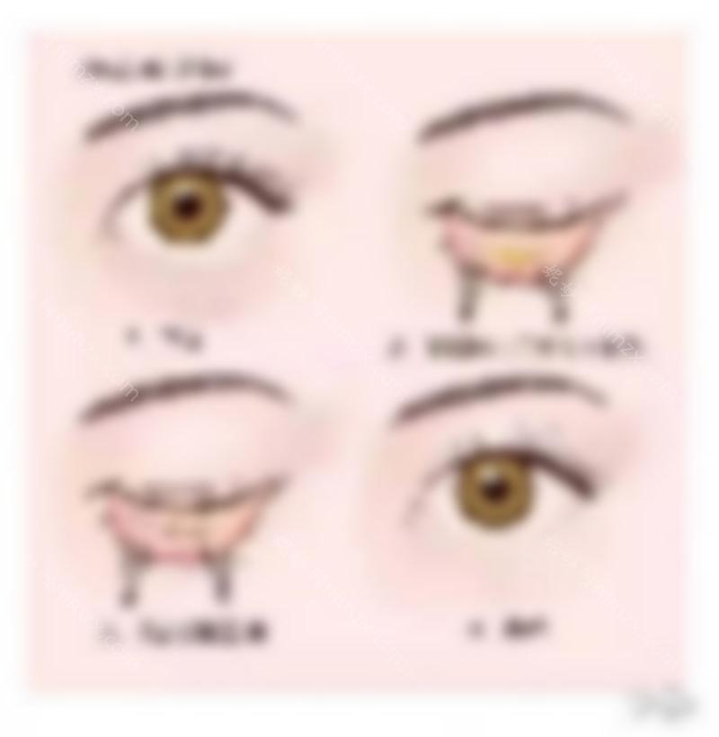 还有人不知道无痕祛眼袋？