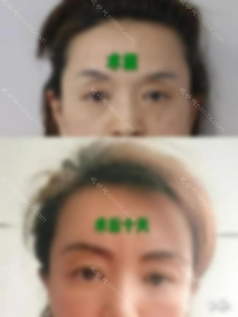 还有人不知道无痕祛眼袋？