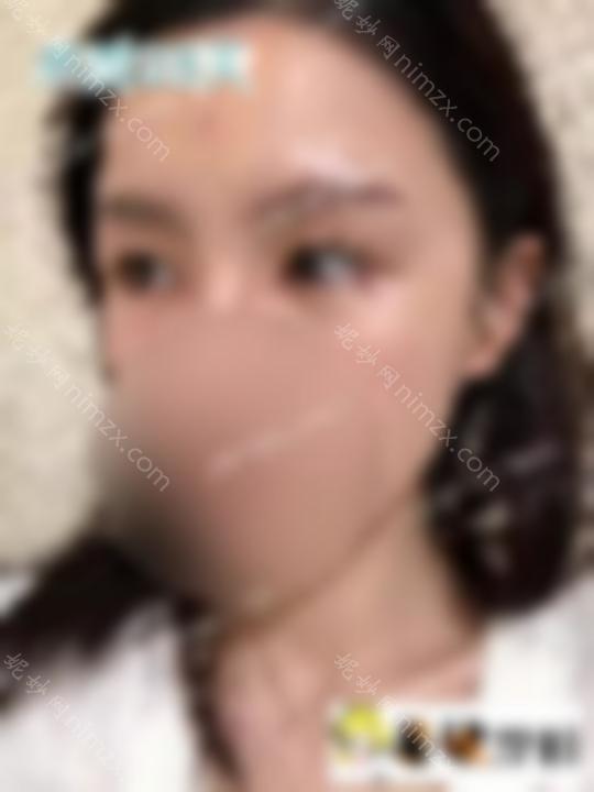 睁开眼睛后，眼睛又老又丑怎么办？开眼角修复手术案例来了！