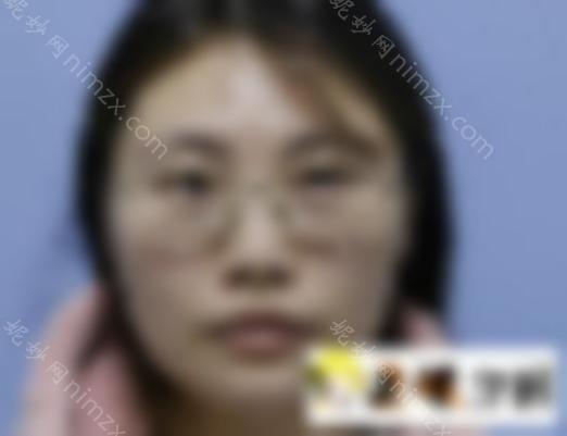 上海华美李志海磨骨怎么样？让我们看看真实的案例