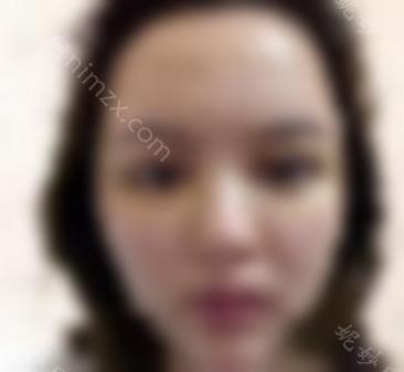 王岩修复双眼皮的案例附上！双眼皮修复效果如何？真人双眼皮修复案例