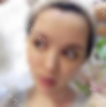 王岩修复双眼皮的案例附上！双眼皮修复效果如何？真人双眼皮修复案例