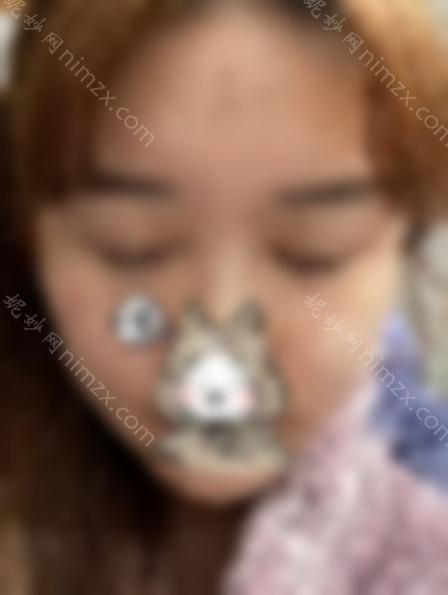 王海平的双眼皮修复好吗？附医生个人简介 修复案例效果图