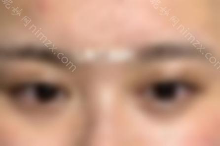 王海平的双眼皮修复好吗？附医生个人简介 修复案例效果图
