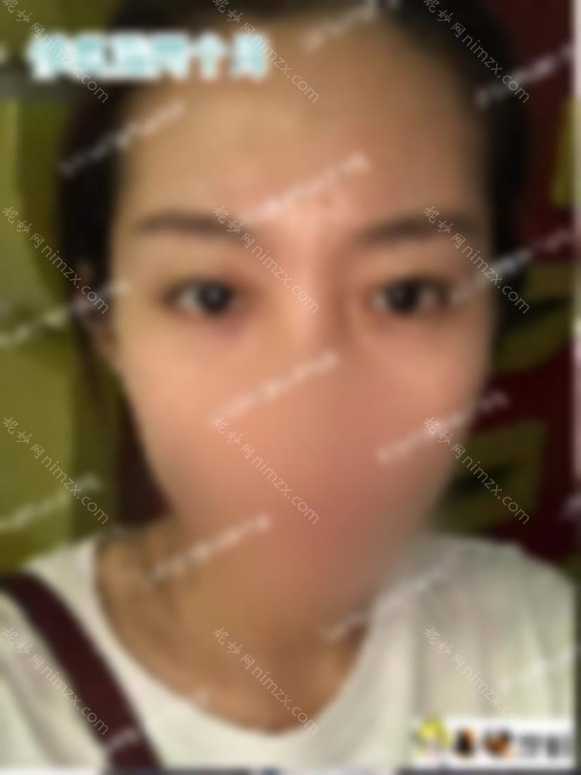 双眼皮修复手术使奇怪的宽双眼皮恢复自然，效果图显示！