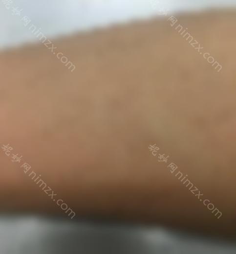 冰激光脱毛效果如何？让我们看看术后的比较