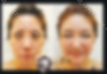 额头填充有副作用吗？自体脂肪填充有哪些优点？