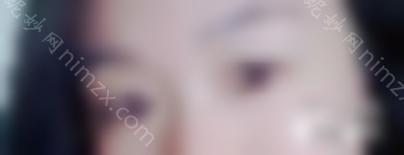 热玛吉眼周年轻化除皱真人效果对比图