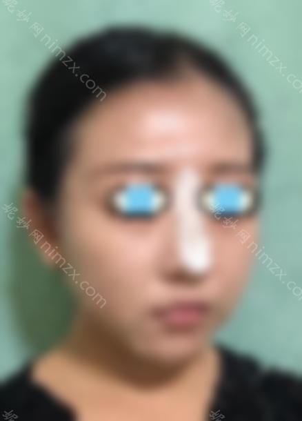 伊维兰注射隆鼻效果好吗？记录真实案例效果~
