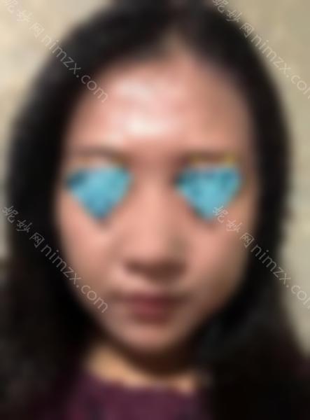 伊维兰注射隆鼻效果好吗？记录真实案例效果~