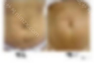 网红热玛吉体验归来，关于第五代FLX所有的问题都在这里