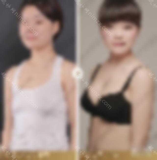 「案例」真人隆胸效果图实拍，隆胸触感与真胸不同？